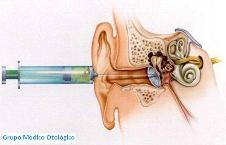 Intratympanic steroid injection for sudden hearing loss