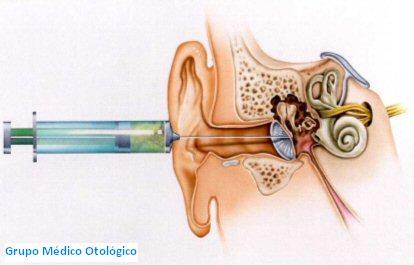 Steroid injection in ear for meniere's